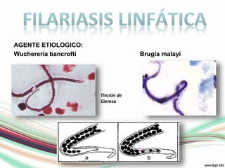 FilariasisLINFÁTICAAGENTE ETIOLOGICO: WuchereriabancroftiBrugiamalayiTinción de Giemsa