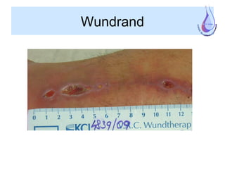 Wundrand
 