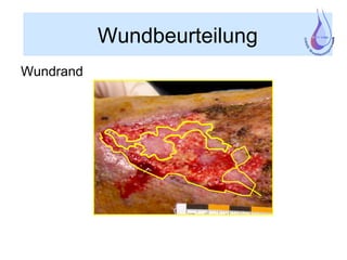 Wundbeurteilung
Wundrand
 