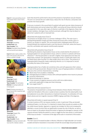 ADVANCES IN WOUND CARE: THE TRIANGLE OF WOUND ASSESSMENT | PDF