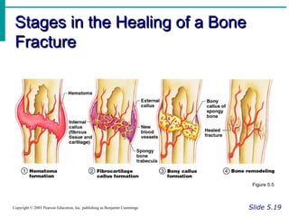 Stages in the Healing of a BoneStages in the Healing of a Bone
FractureFracture
Slide 5.19Copyright © 2003 Pearson Education, Inc. publishing as Benjamin Cummings
Figure 5.5
 