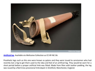 Artificial leg. Available via Wellcome Collection as CC-BY-NC-SA.

Prosthetic legs such as this one were known as pylons and they were issued to servicemen who had
recently lost a leg to get them used to the idea and feel of an artificial leg. They would be worn for a
short period before a proper artificial limb was fitted. Made from fibre with leather padding, the leg
was issued by a Red Cross provisional limb depot in Stretford, Manchester, England.
 