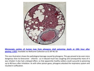 Microscopic section of human lung from phosgene shell poisoning: death at 19th hour after
gassing, c.1917. Available via Wellcome Collection as CC-BY-NC-SA

This rare illustration shows the pathological damage caused by phosgene. This gas proved to be even more
dangerous than its forerunner - chlorine - as it induced much less coughing and consequently more of it
was inhaled. It also had a delayed effect, so that apparently healthy soldiers could succumb to poisoning
up to 48 hours after inhalation. As with other poison gases, phosgene attacked the respiratory system and
resulted in suffocation.
 
