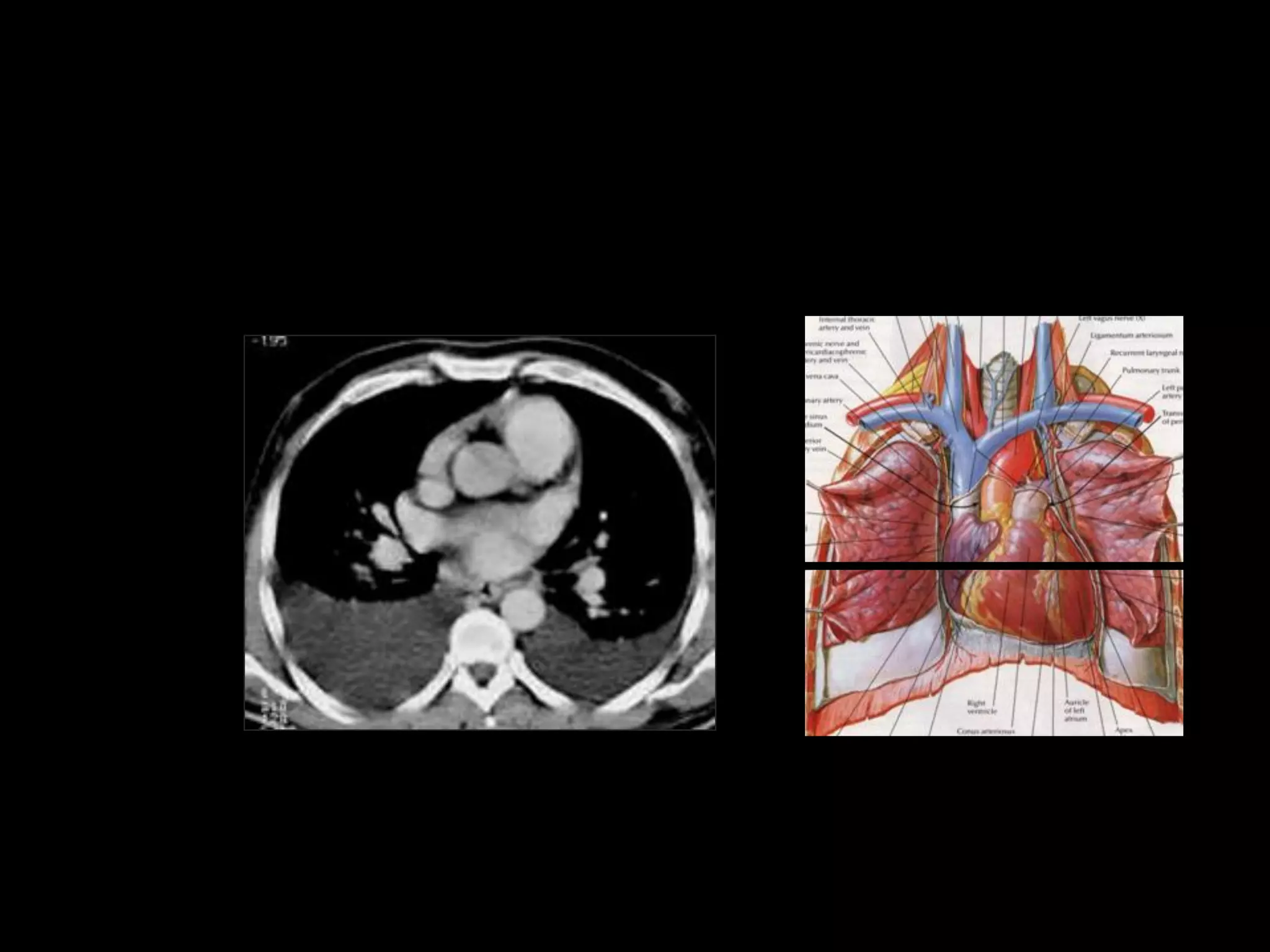 Segmental anatomy of lungs , anatomy of mediastinum and secondary ...