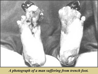 A photograph of a man suffering from trench foot.
 