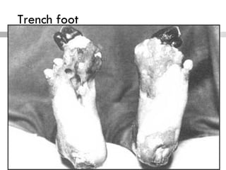 Trench foot
 