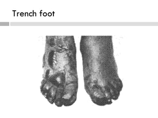 Trench foot
 