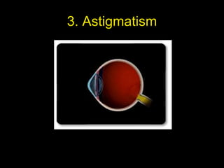 3. Astigmatism 
 