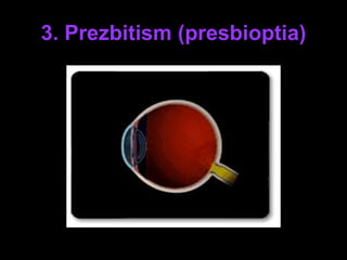 3. Prezbitism (presbioptia) 
 