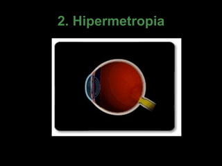 2. Hipermetropia 
 