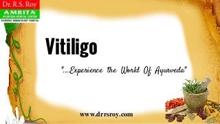 www.drrsroy.com
Vitiligo
"....Experience the World Of Ayurveda"
 