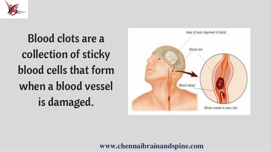 Blood Clot In Brain Treatment In Chennai Neurologist In India