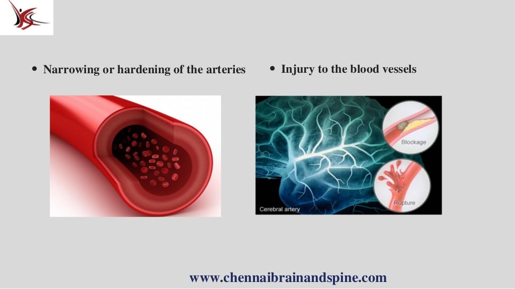 Blood Clot In Brain Treatment In Chennai Neurologist In India