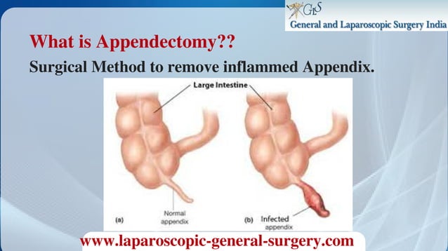Appendix Removal Surgery In Bangalore | Laparoscopic Appendicitis ...