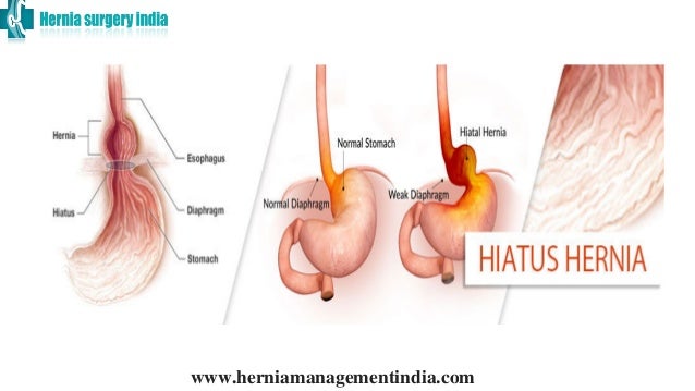 Hiatus Hernia Treatment In Chennai Hernia Repair Surgery