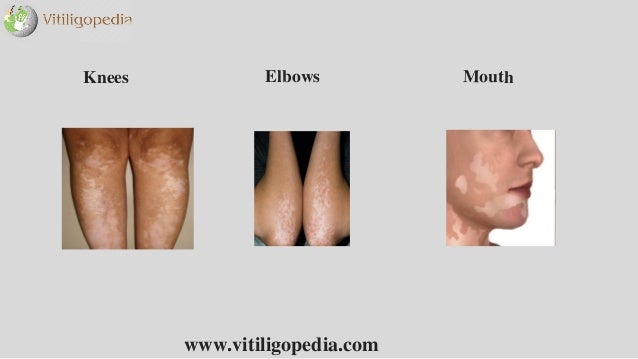 Vitiligo Treatment Centre In Bangalore | White Spot Removal In India