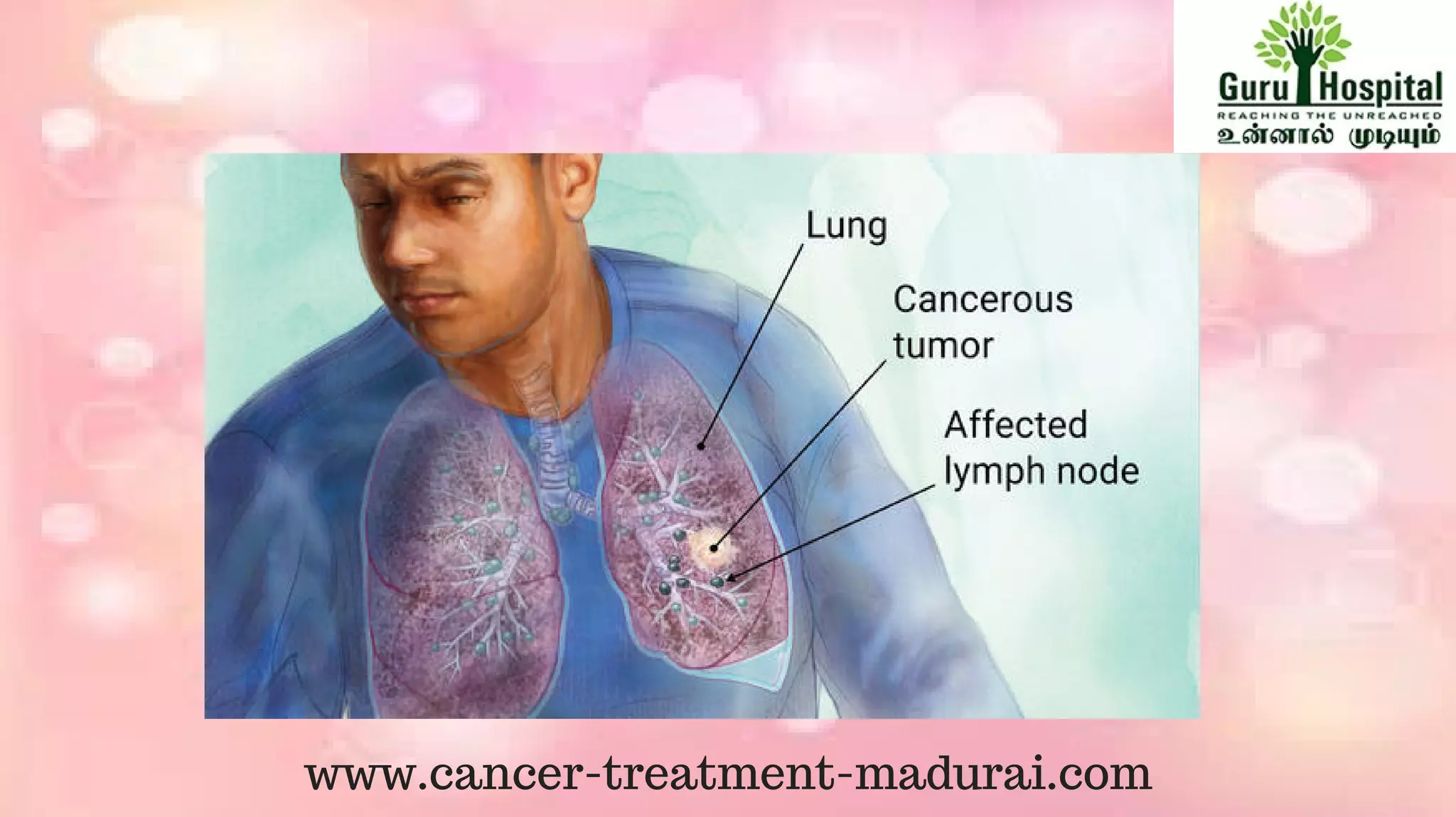 Lung Cancer Treatment In Madurai | Best Cancer Hospital In India | PPT