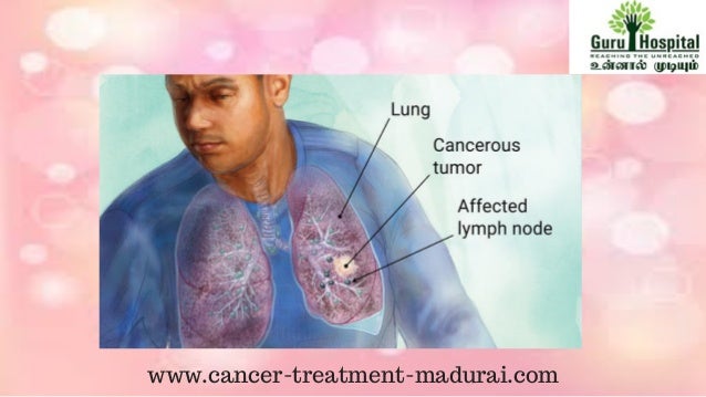 Best hospitals to treat lung cancer