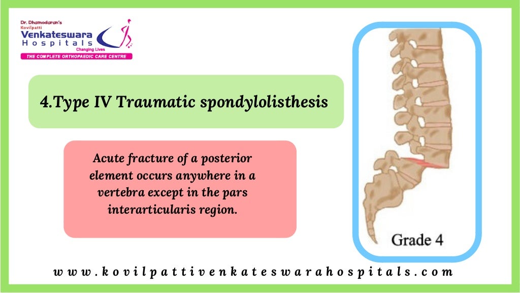 Spondylolisthesis Slipped Vertebrae Treatment Degenerative