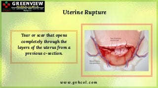 w w w . g v h c o l . c o m
Uterine Rupture
Tear or scar that opens
completely through the
layers of the uterus from a
pre...