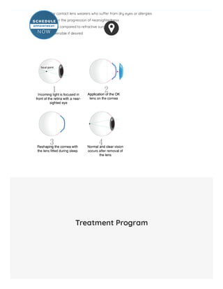 Great for contact lens wearers who su er from dry eyes or allergies
Slows down the progression of nearsightedness
Less costly compared to refractive surgeries
Easily reversible if desired
Treatment Program
 