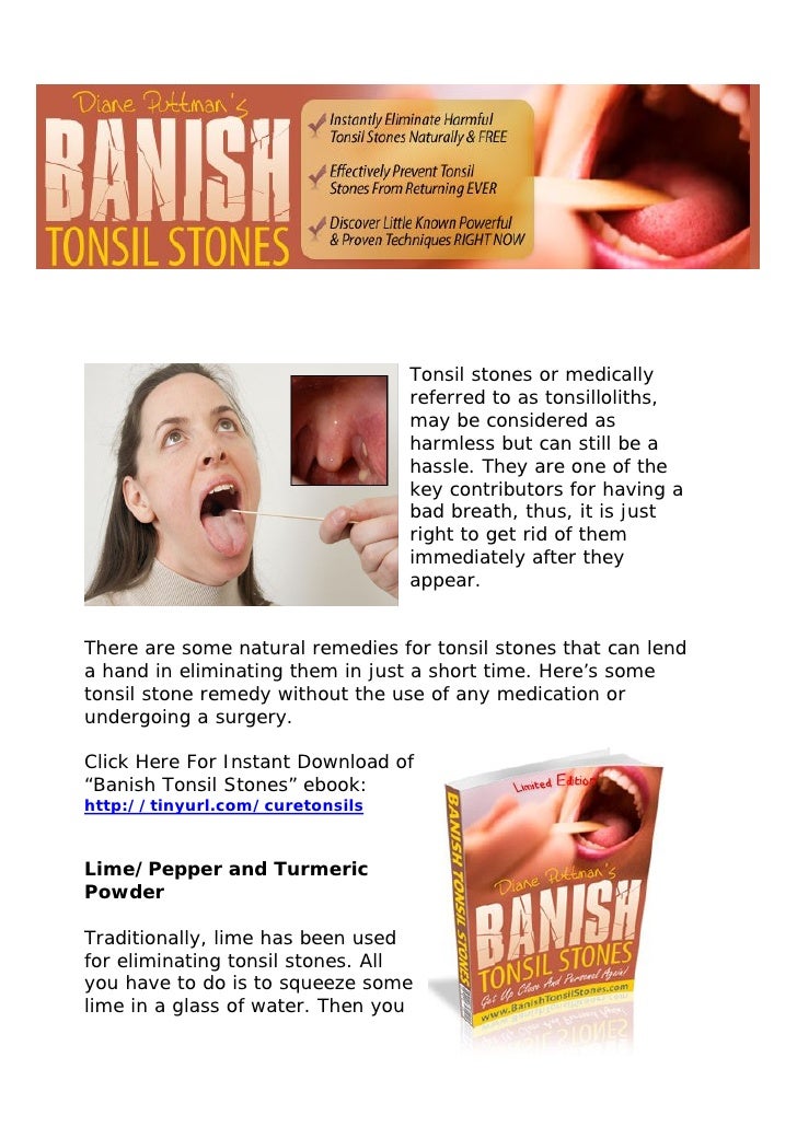 A Simple Guide to Cure Tonsil Stones