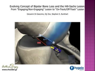www.shoulder.gr
Evolving Concept of Bipolar Bone Loss and the Hill-Sachs Lesion:
From “Engaging/Non-Engaging” Lesion to “O...