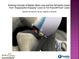 www.shoulder.gr
Evolving Concept of Bipolar Bone Loss and the Hill-Sachs Lesion:
From “Engaging/Non-Engaging” Lesion to “O...