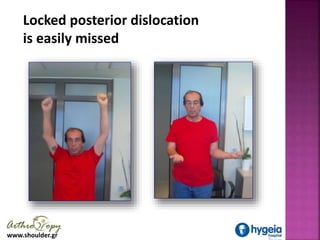 www.shoulder.gr
Locked posterior dislocation
is easily missed
 
