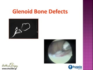 www.shoulder.gr
Glenoid Bone Defects
 