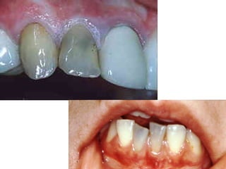 Endodontie: Die Rettung  von toten Zähnen 