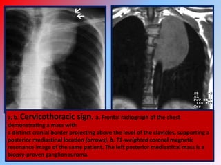 Martel Sign Radiograph X.ray pearls 1 | PPTX