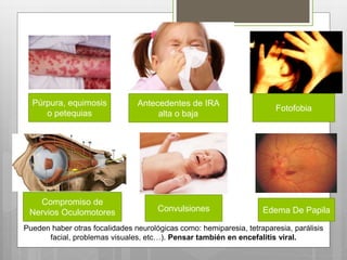 Pueden haber otras focalidades neurológicas como: hemiparesia, tetraparesia, parálisis
facial, problemas visuales, etc…). Pensar también en encefalitis viral.
Púrpura, equimosis
o petequias
Antecedentes de IRA
alta o baja
Fotofobia
Compromiso de
Nervios Oculomotores Convulsiones Edema De Papila
 