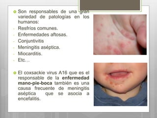  Son responsables de una gran
variedad de patologías en los
humanos:
- Resfríos comunes.
- Enfermedades aftosas.
- Conjuntivitis
- Meningitis aséptica.
- Miocarditis.
- Etc…
 El coxsackie virus A16 que es el
responsable de la enfermedad
mano-pie-boca también es una
causa frecuente de meningitis
aséptica que se asocia a
encefalitis.
 