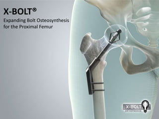 X-BOLT®
Expanding Bolt Osteosynthesis
for the Proximal Femur
 