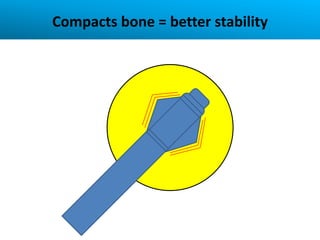 Compacts bone = better stability
 