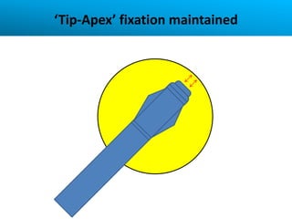‘Tip-Apex’ fixation maintained
 