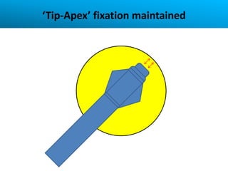‘Tip-Apex’ fixation maintained
 