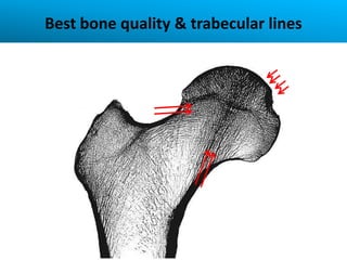 Best bone quality & trabecular lines
 