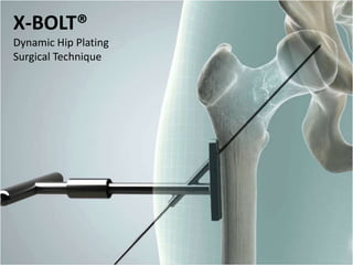 X-BOLT®
Dynamic Hip Plating
Surgical Technique
 