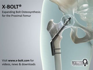 X-BOLT®
Expanding Bolt Osteosynthesis
for the Proximal Femur




Visit www.x-bolt.com for
videos, news & downloads
 