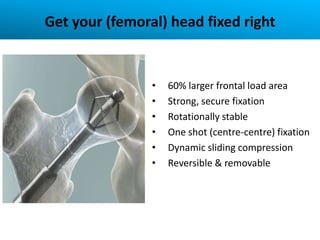 Get your (femoral) head fixed right


                •   60% larger frontal load area
                •   Strong, secure fixation
                •   Rotationally stable
                •   One shot (centre-centre) fixation
                •   Dynamic sliding compression
                •   Reversible & removable
 