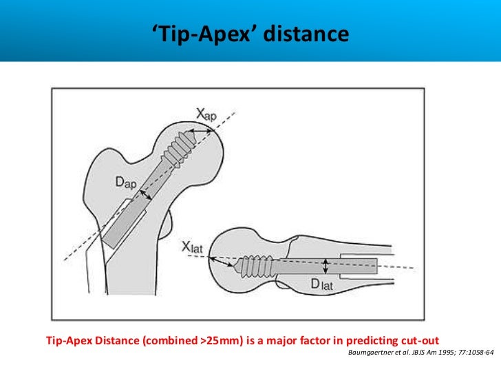 Hip Fracture Fixation With X Bolt