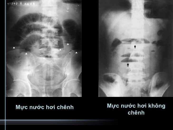 X quang liềm hơi dưới cơ hoành