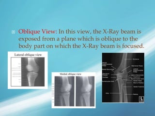  Oblique View: In this view, the X-Ray beam is
exposed from a plane which is oblique to the
body part on which the X-Ray beam is focused.
 