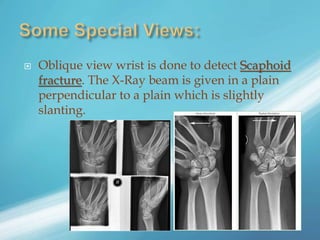  Oblique view wrist is done to detect Scaphoid
fracture. The X-Ray beam is given in a plain
perpendicular to a plain which is slightly
slanting.
 