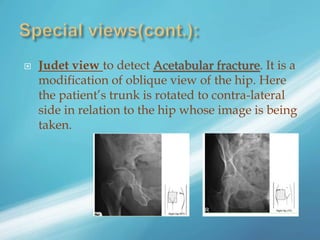  Judet view to detect Acetabular fracture. It is a
modification of oblique view of the hip. Here
the patient’s trunk is rotated to contra-lateral
side in relation to the hip whose image is being
taken.
 