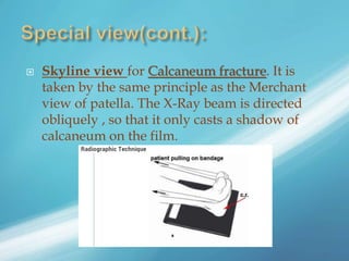  Skyline view for Calcaneum fracture. It is
taken by the same principle as the Merchant
view of patella. The X-Ray beam is directed
obliquely , so that it only casts a shadow of
calcaneum on the film.
 