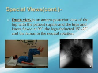  Dunn view is an antero-posterior view of the
hip with the patient supine and the hips and
knees flexed at 90˚, the legs abducted 15˚ -20˚,
and the femur in the neutral rotation.
 