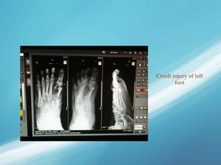 Crush injury of left
foot
 